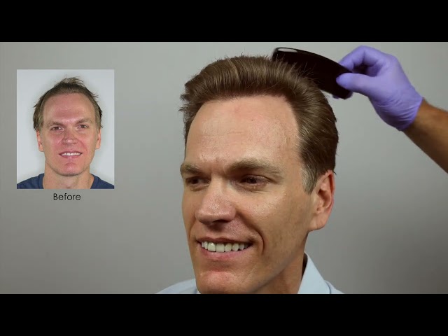 Hair Transplant Close Up Comb Through - Undetectable FUE Hair Transplant Results