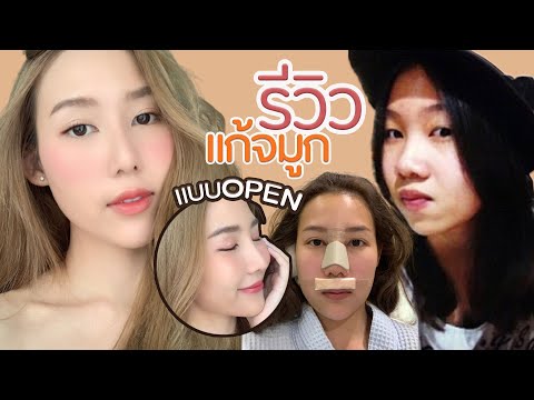 รีวิวแก้จมูกแบบ Open หน้าหวานละมุน ทรงสวยมาก | Prawwave
