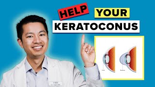 Everything You Need to Know About Your Keratoconus!!!
