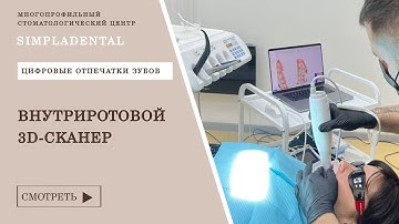 Технология снятия слепков. Как работает внутриротовой 3D - сканер.