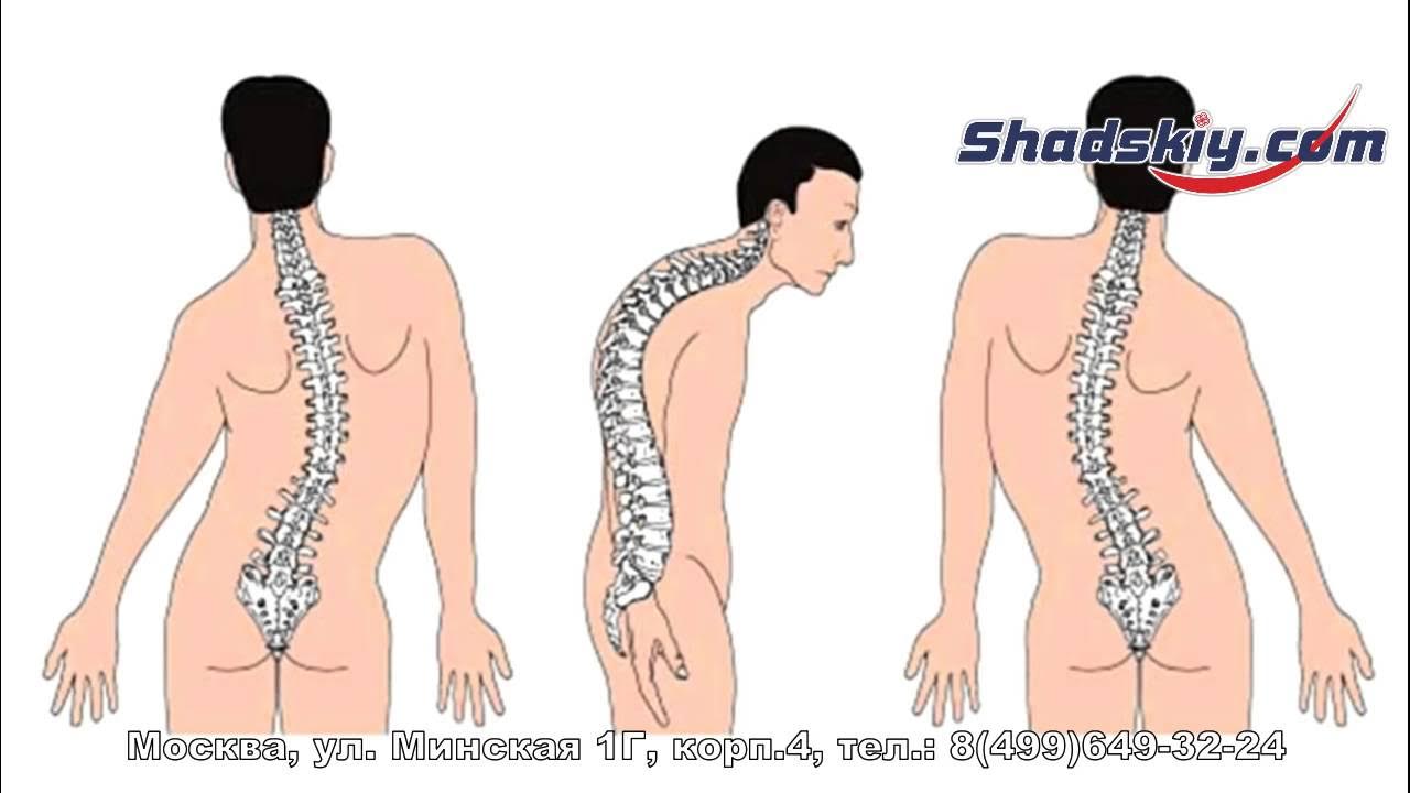 Искривление поясничного позвоночника. Искривление грудного отдела позвоночника кифоз. Сколиоз кифоз кифосколиоз. Лордоз кифоз сколиоз. Осанка лордоз кифоз сколиоз.
