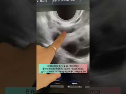 Ответ яичников на стимуляцию и АМГ - Центре ЭКО Виталис