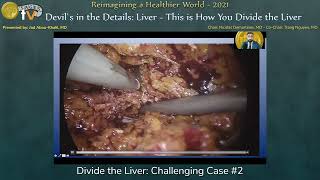 Divide the Liver: Challenging Case #2