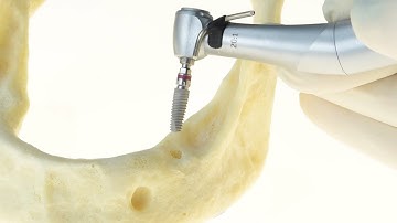 How to place a Ø4.2x11.5mm C1 dental implant