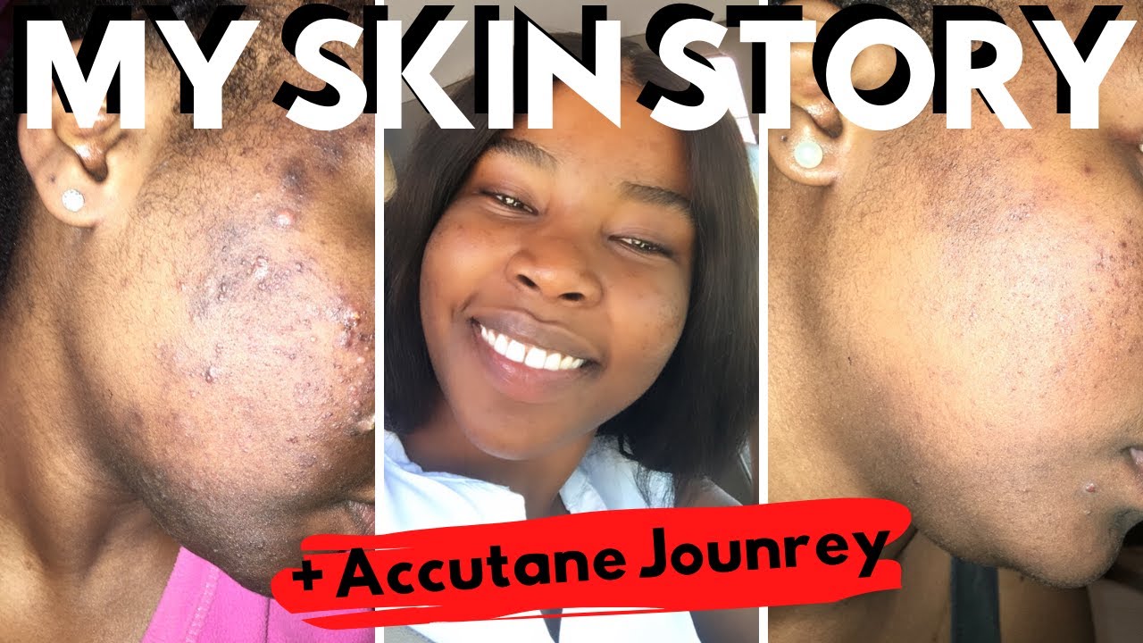 persivate cream for dark spots