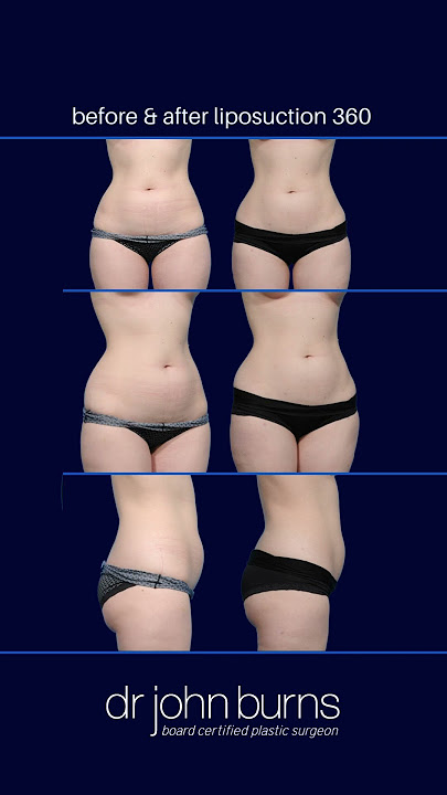 Optimizing Your Lipo Results- Dallas Plastic Surgeon, Dr. John