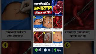 অ্যাপেন্ডিক্স রোগ থেকে বাঁচার আগে এই সার্জারি জানুন #সচেতনতা #অপারেশন#shorts #shortvideo