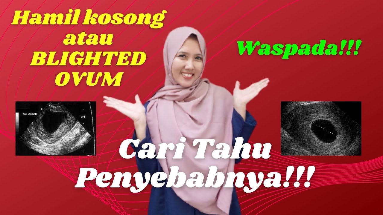 Hamil Kosong Atau BLIGHTED OVUM (BO) | Kenali Penyebabnya !!! Waspada