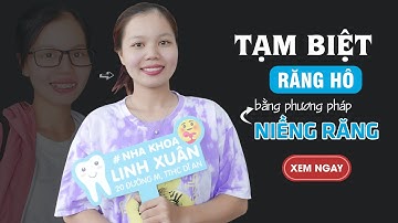 Lột xác ngoạn mục sau quá trình niềng răng hô - Niềng răng đẹp cỡ nào?