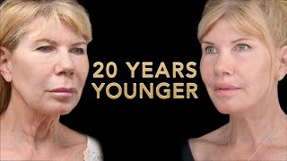 Ponytail Facelift Before and After Part 1   Facial Rejuvenation