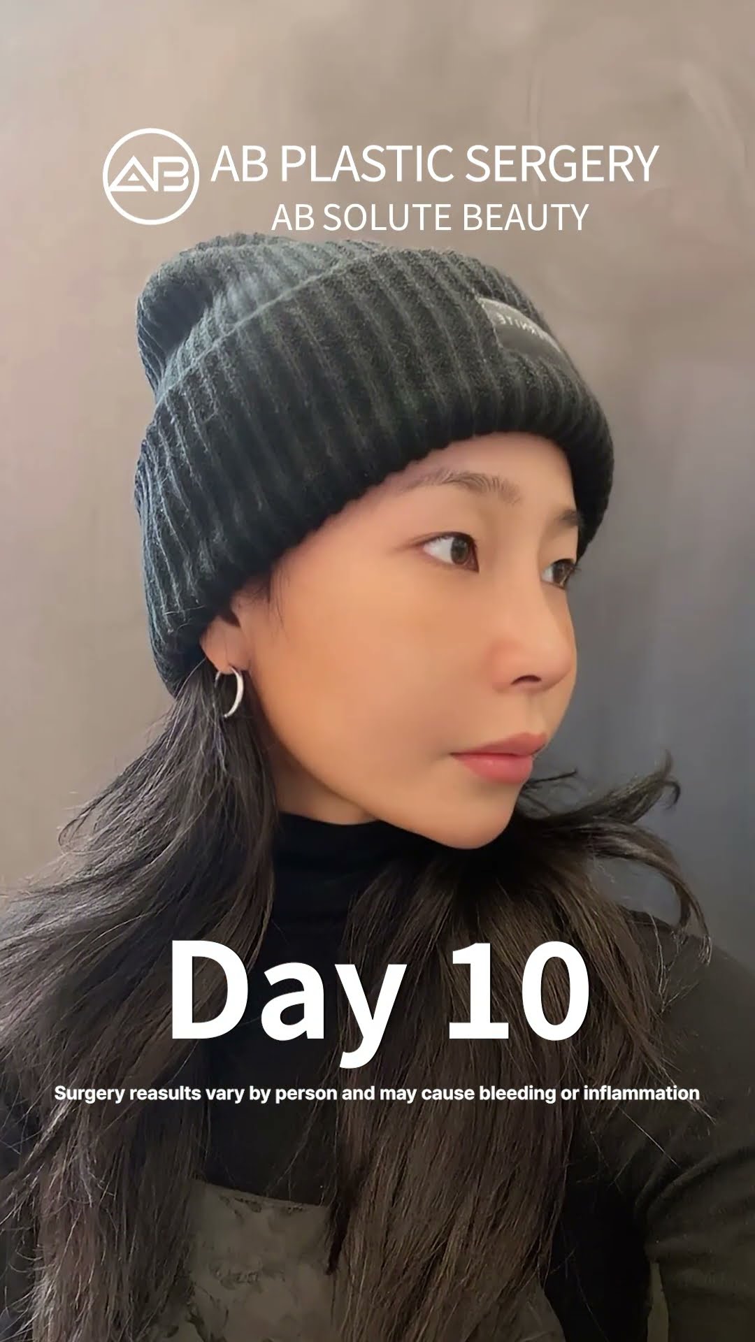 Jawline & Nose Transformation Vietnamese Beauty’s Stunning Glow-Up #shorts