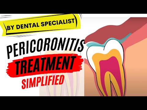 Pericoronitis Treatment | Causes & Symptoms