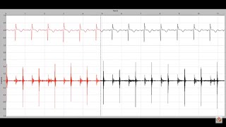 Holosystolic murmur in a child with a membranous ventricular ...