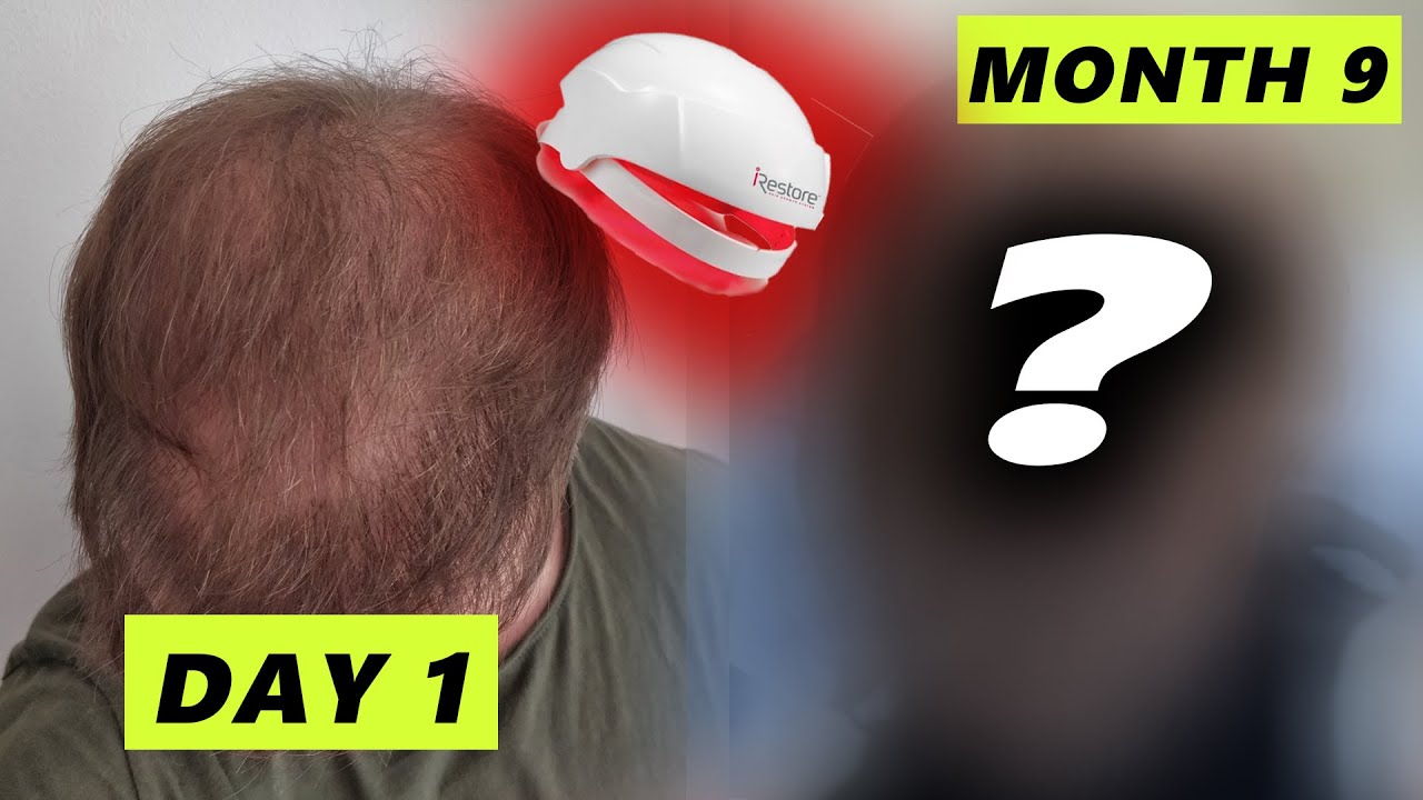 No Laser Hair REGROWTH with Laser Cap :((( 9 Months Before and After -  YouTube