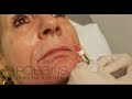 RESTYLANE FILLER- Top Rated Nashville Plastic Surgeon - Robbins Plastic Surgery