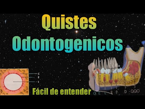 Video: ¿Cuántos tipos de quistes dentígeros existen?