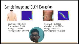 Presentation CSC566 Group Project (Psoriasis Skin Disease Image Classification using GLCM and KNN)