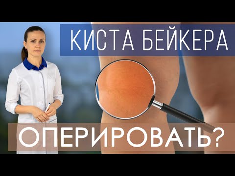 Киста Бейкера. Как лечить кисту Бейкера коленного сустава? Всегда ли нужно оперировать? Упражнения.