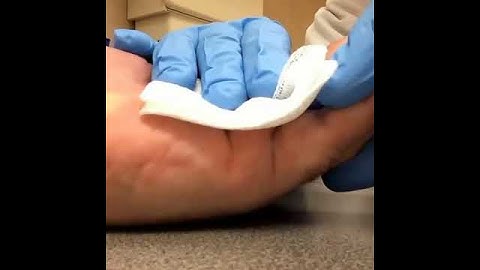 Xiaflex Dupuytrens  Cord breaks in slo-mo