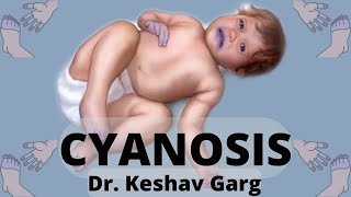 CYANOSIS