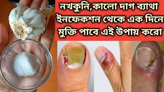 নখকুনী,নখে ব্যাথা,নখ ফোলা, কালো দাগ, নখের ফাঙ্গাস থেকে মুক্তি পাবে/Toenail,nail fungus treatment screenshot 4