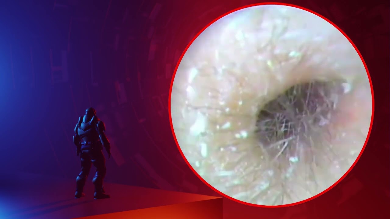 The Truth About earwax Will Shock You. How to remove earwax from ear, earwax extractions