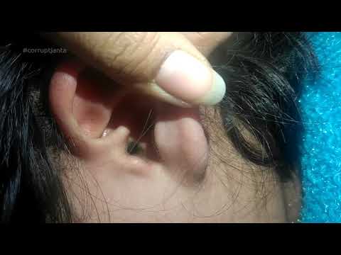 Stuck Paper inside Ear - Removal || Glitter Sheet Piece REMOVED FROM EAR