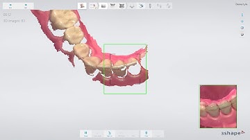 3Shape 임플란트 스튜디오 – 트리오스 사용한 서지컬 가이드 스캔 방법(Free End 케이스) -Implant Studio: How to Scan - Free end case