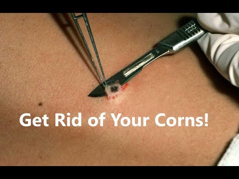 Simple Trick for Corns on Feet *Home Cure*