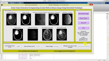 Brain Tumor Detection using Watershed Technique matlab project code