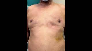Shocking Gynecomastia Transformation 😱 Before After | Jaipur | Dr. Deepesh Goyal