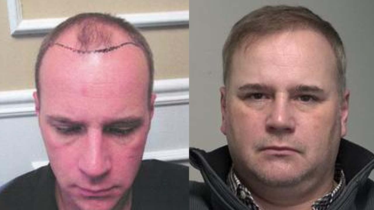 Hair Transplant Atlanta Before and After HRS of Atlanta YouTube