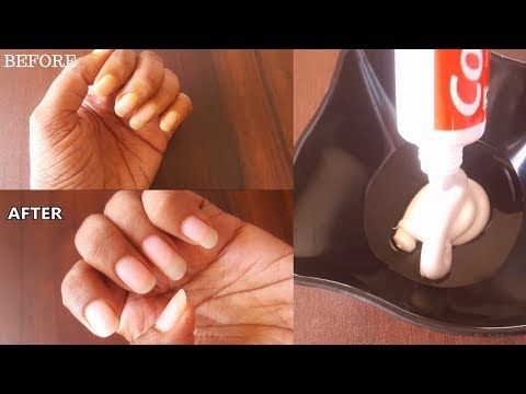 Video: Why Do I Smear My Nails With Toothpaste