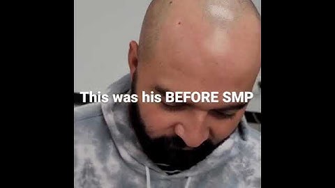 Scalp Micropigmentation