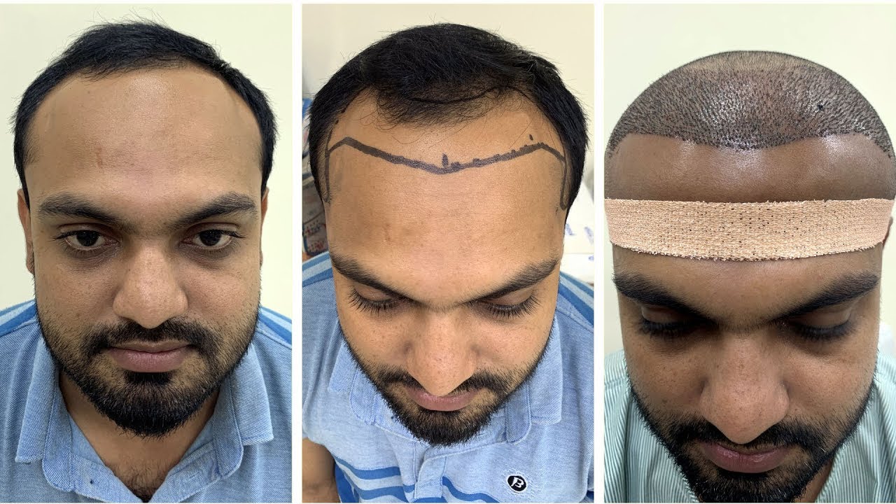 Hair Transplant In Kolkata কলকাতায় হেয়ার ট্রান্সপ্ল্যান্ট YouTube
