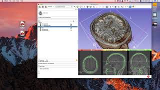 Brain volume rendering (using 3D slicer)