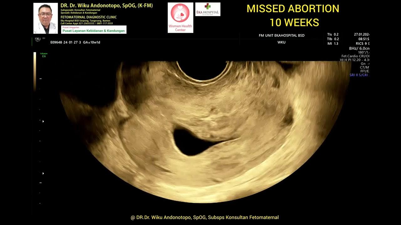 Missed Abortion 10 weeks YouTube