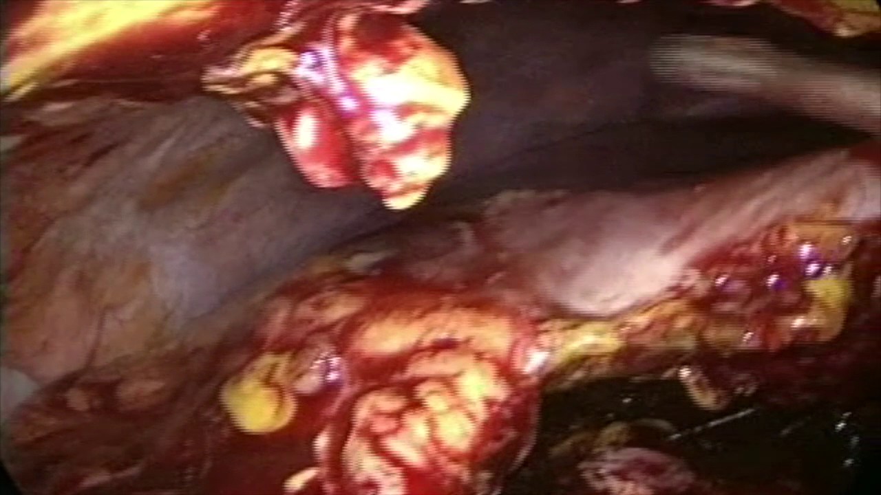  Laparoscopía Diagnóstica