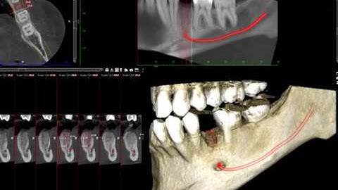 Graft material in CBCT