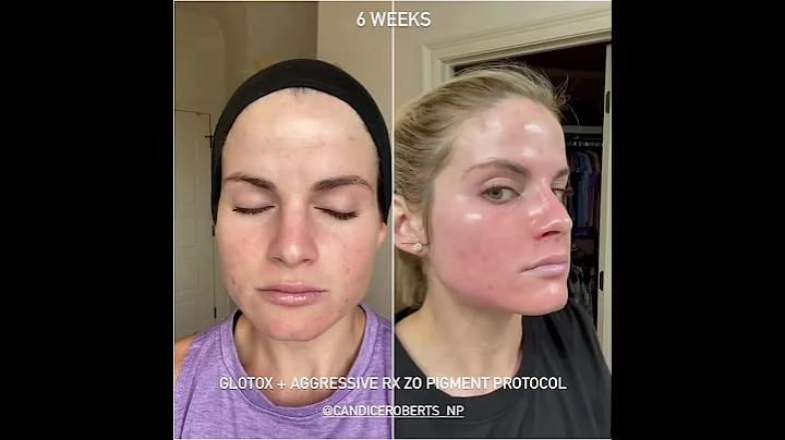 GloTox + Aggressive ZO Pigment Protocol