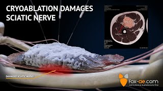 Cryoablation Damages Sciatic Nerve