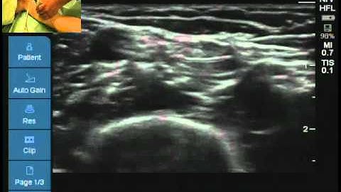 Locating median ulnar and musculocutaneous nerve for axillary block