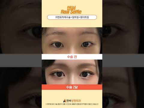 쌍꺼풀재수술+앞트임+원더트임(뒤트임+눈꼬리내리기) 2달 후기