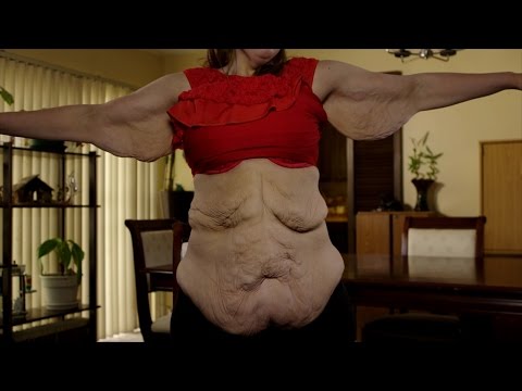 They've Lost the Weight But Not the Skin