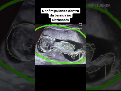 Neném pulandinho #gestante #gravidez #ultrassom #bebe