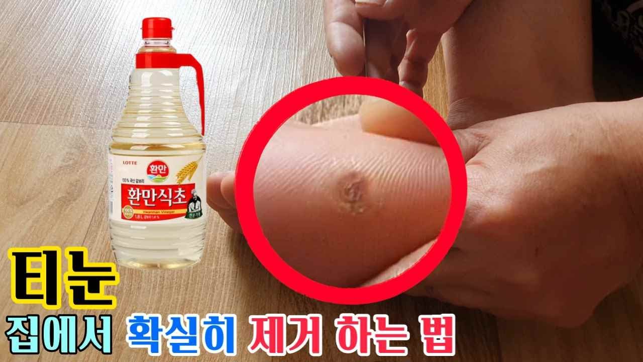 💥💛티눈 집에서 쉽고 확실하게 제거 하는 방법( How to remove easily and reliably from corn )