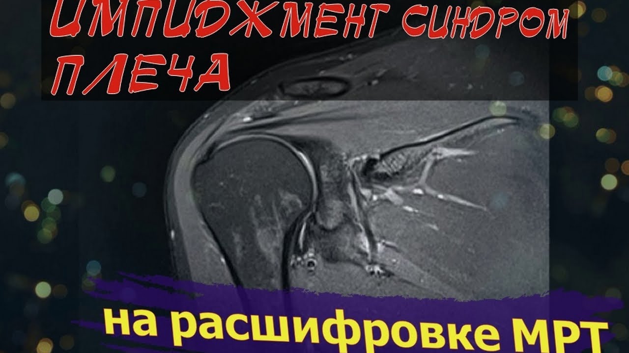 ИМПИДЖМЕНТ СИНДРОМ плечевого сустава и ДЕГЕНЕРАТИВНЫЕ ИЗМЕНЕНИЯ по типу ...