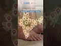 Diabetic Foot Care in Ranchi #shorts #ytshorts #diabeticfootcare #diabetes