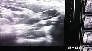 suspicious submandibular lymph node | US