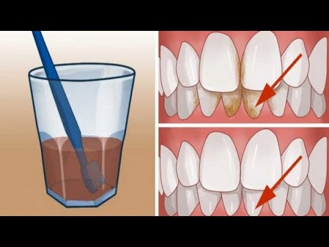 Βίντεο: 3 τρόποι για να απαλλαγείτε από μια μόλυνση των δοντιών
